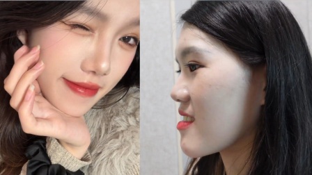 24岁女孩做完正颌手术后